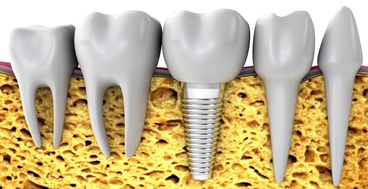 Osseointegration, if you have sufficient bone for implants